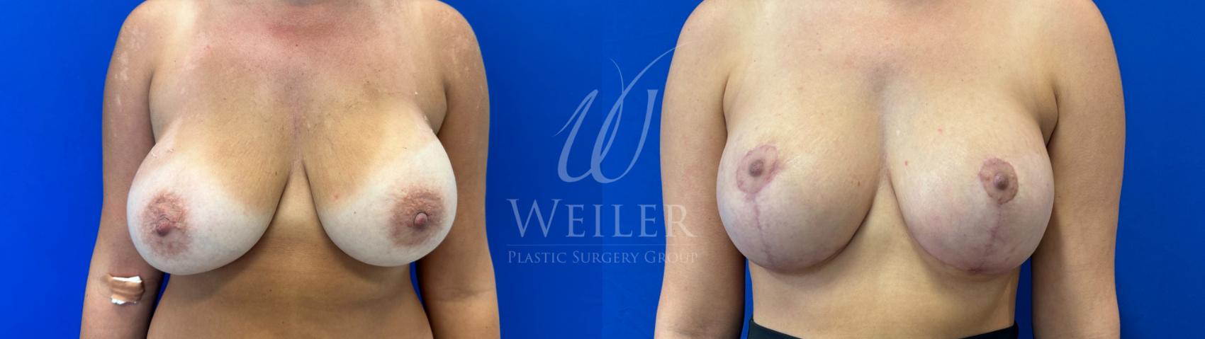 Before & After Breast Lift with Augmentation Case 1772 Front View in Baton Rouge, New Orleans, & Lafayette, Louisiana
