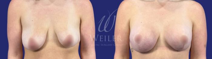 Before & After Breast Lift with Augmentation Case 1786 Front View in Baton Rouge, New Orleans, & Lafayette, Louisiana