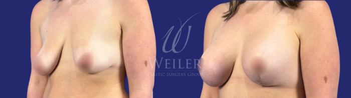 Before & After Breast Lift with Augmentation Case 1786 Left Oblique View in Baton Rouge, New Orleans, & Lafayette, Louisiana