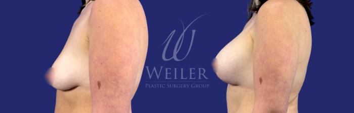 Before & After Breast Lift with Augmentation Case 1786 Left Side View in Baton Rouge, New Orleans, & Lafayette, Louisiana
