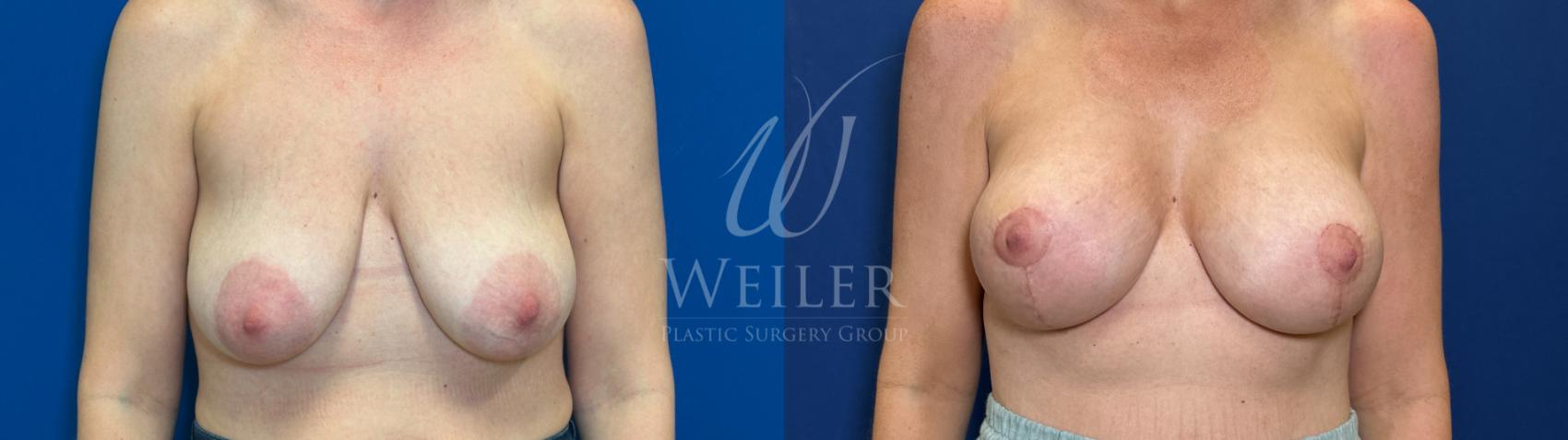 Before & After Breast Lift with Augmentation Case 1789 Front View in Baton Rouge, New Orleans, & Lafayette, Louisiana