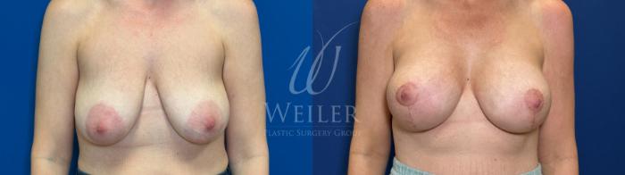 Before & After Breast Lift with Augmentation Case 1789 Front View in Baton Rouge, New Orleans, & Lafayette, Louisiana