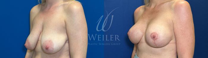 Before & After Breast Lift with Augmentation Case 1789 Left Oblique View in Baton Rouge, New Orleans, & Lafayette, Louisiana
