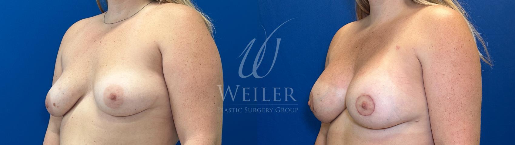 Before & After Breast Lift with Augmentation Case 1791 Left Oblique View in Baton Rouge, New Orleans, & Lafayette, Louisiana