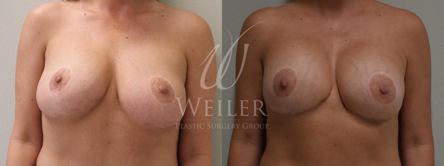 Before & After Breast Lift with Augmentation Case 198 View #1 View in Baton Rouge, New Orleans, & Lafayette, Louisiana