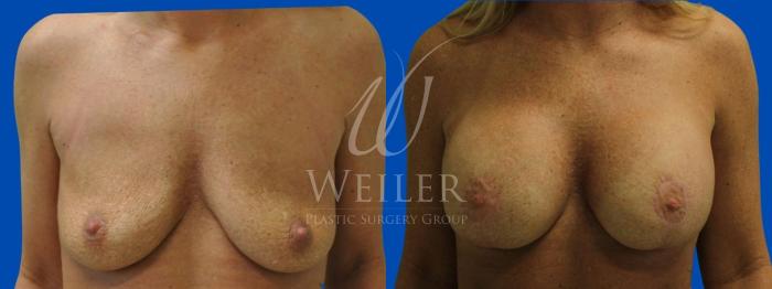 Before & After Breast Lift with Augmentation Case 212 View #1 View in Baton Rouge, New Orleans, & Lafayette, Louisiana
