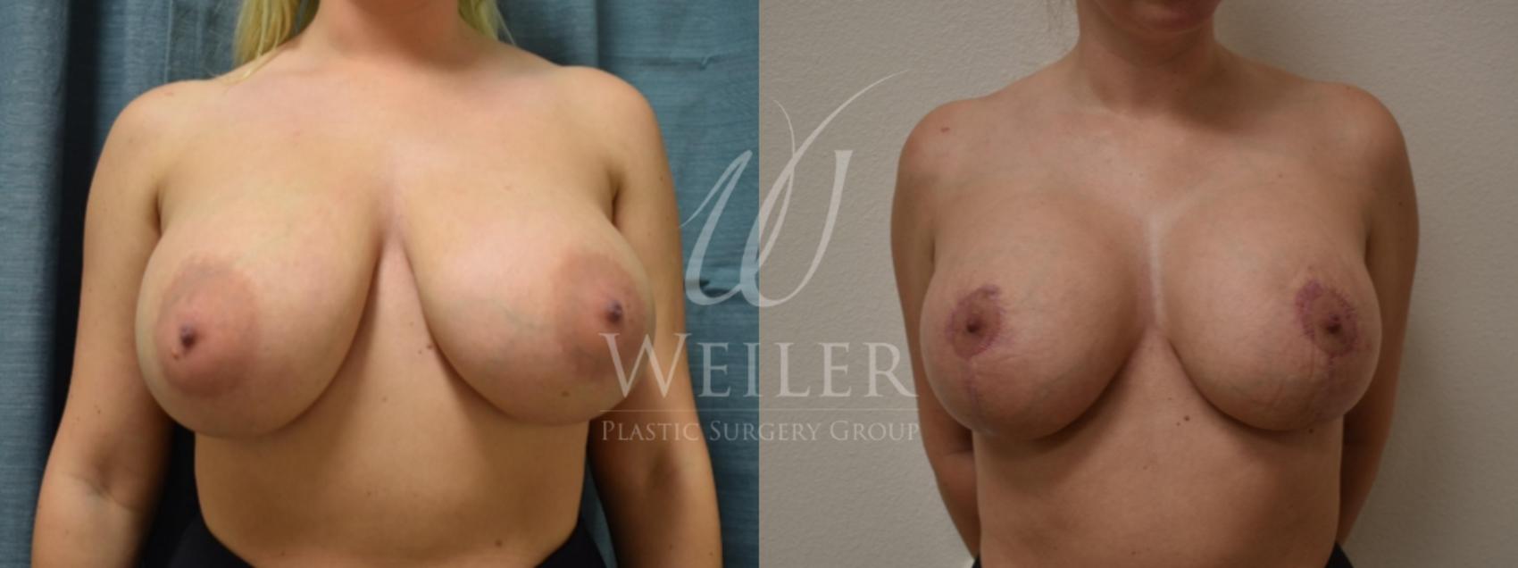 Before & After Breast Lift with Augmentation Case 239 View #1 View in Baton Rouge, New Orleans, & Lafayette, Louisiana