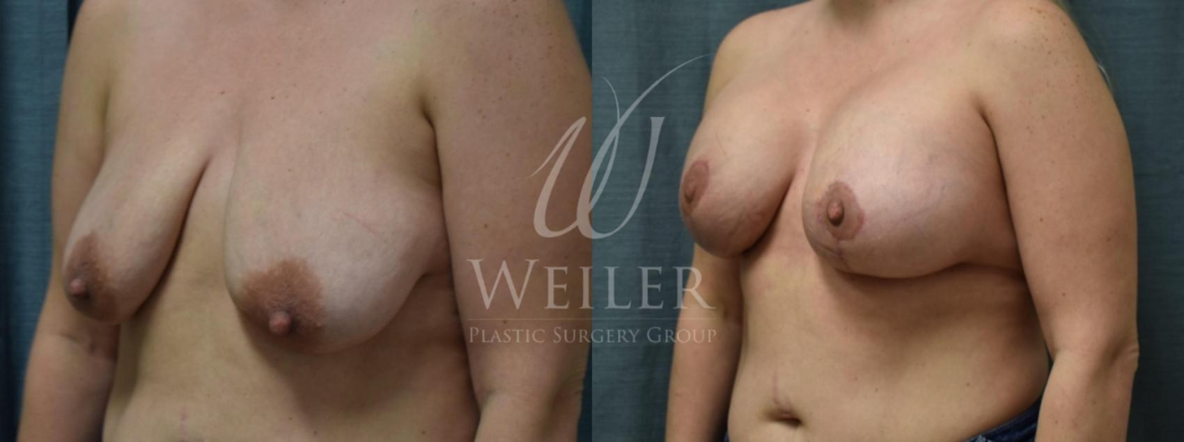 Before & After Breast Lift with Augmentation Case 303 View #1 View in Baton Rouge, New Orleans, & Lafayette, Louisiana