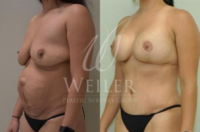 Before & After Breast Lift with Augmentation Case 326 Left Oblique View in Baton Rouge, New Orleans, & Lafayette, Louisiana