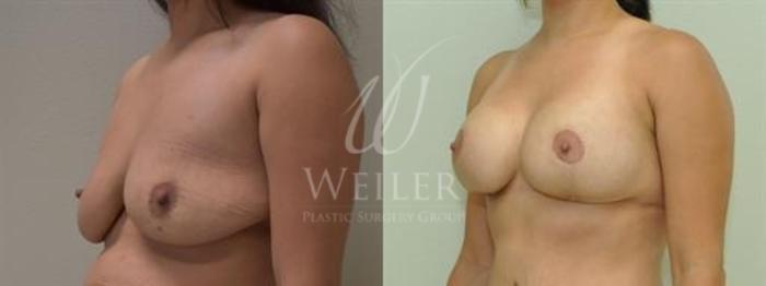 Before & After Breast Lift with Augmentation Case 326 View #1 View in Baton Rouge, New Orleans, & Lafayette, Louisiana