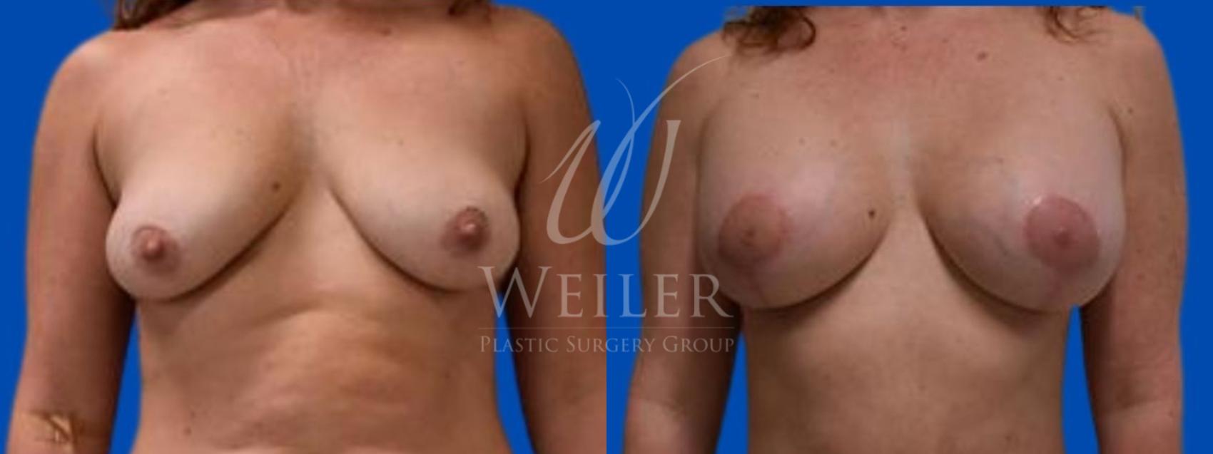 Before & After Breast Lift with Augmentation Case 330 View #1 View in Baton Rouge, New Orleans, & Lafayette, Louisiana