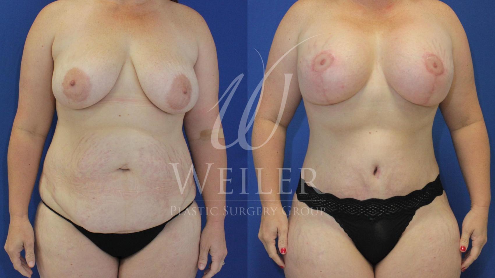 Before & After Tummy Tuck Case 467 Front View in Baton Rouge, New Orleans, & Lafayette, Louisiana
