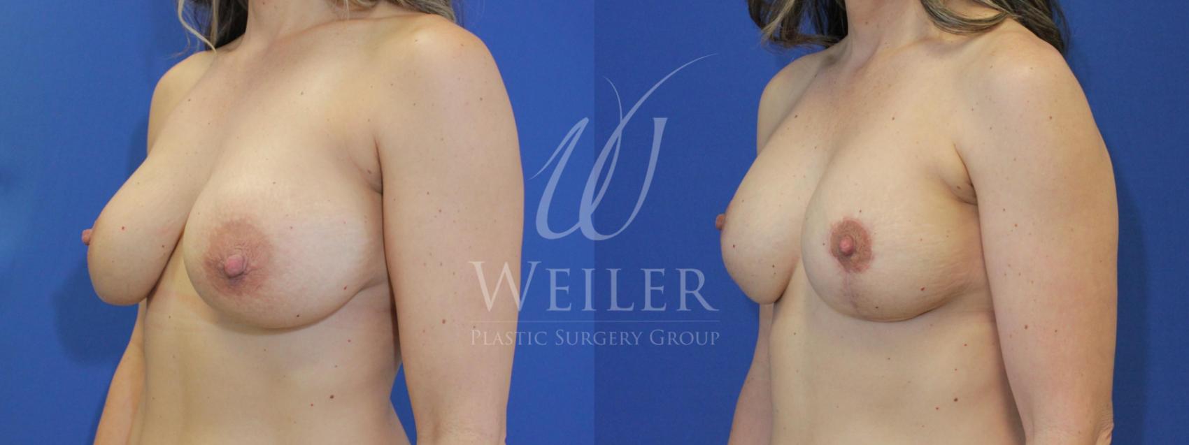 Before & After Breast Lift with Augmentation Case 560 Left Oblique View in Baton Rouge, Louisiana