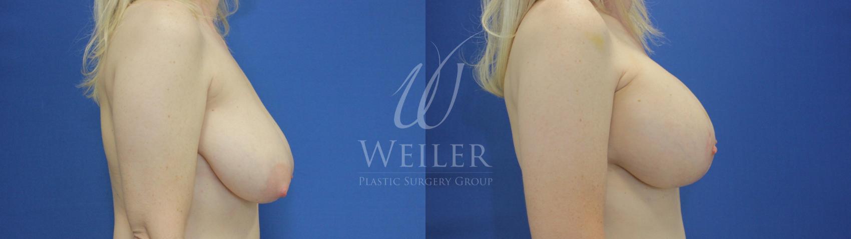 Before & After Breast Lift with Augmentation Case 584 Right Side View in Baton Rouge, New Orleans, & Lafayette, Louisiana
