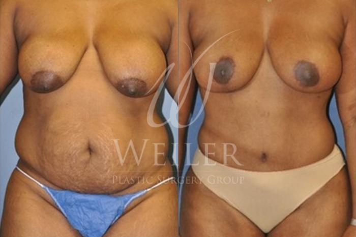 Before & After Breast Lift with Augmentation Case 70 Front View in Baton Rouge, New Orleans, & Lafayette, Louisiana