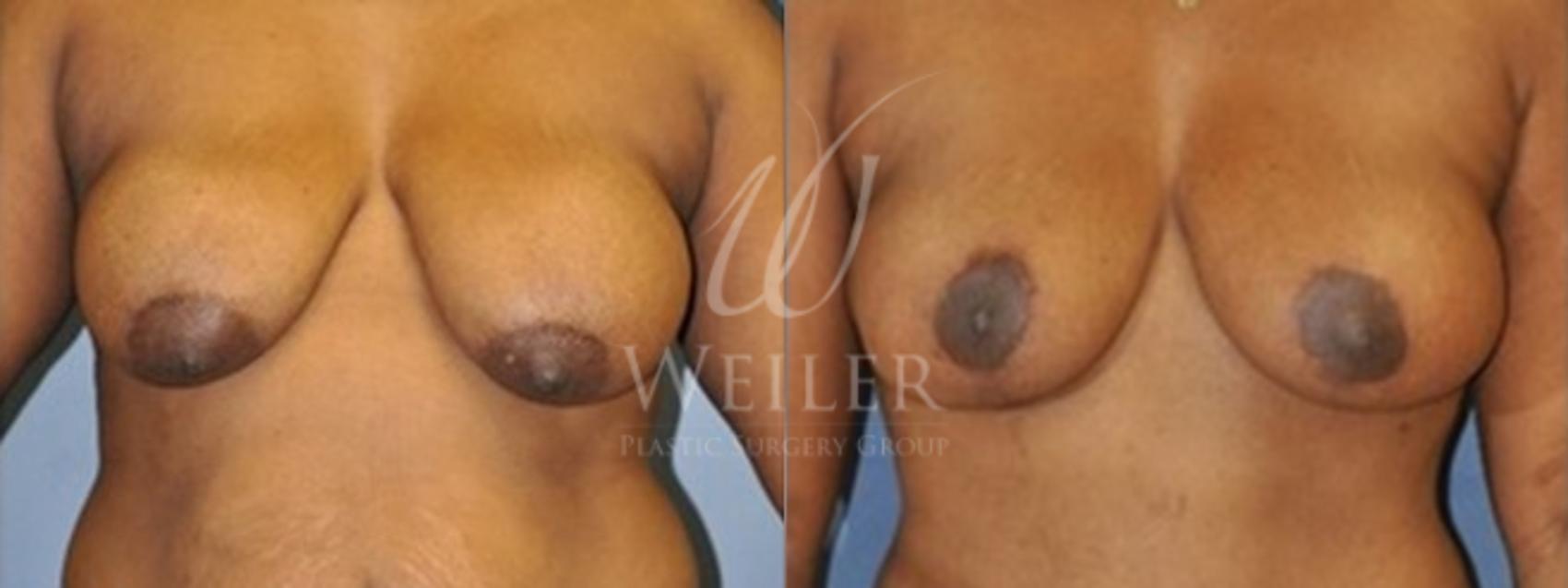 Before & After Breast Lift with Augmentation Case 70 View #1 View in Baton Rouge, New Orleans, & Lafayette, Louisiana