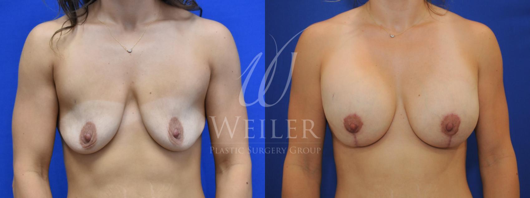 Before & After Breast Lift with Augmentation Case 734 Front View in Baton Rouge, New Orleans, & Lafayette, Louisiana