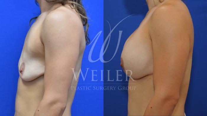 Before & After Breast Lift with Augmentation Case 734 Left Side View in Baton Rouge, New Orleans, & Lafayette, Louisiana