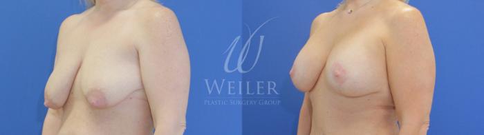 Before & After Breast Lift with Augmentation Case 789 Left Oblique View in Baton Rouge, Louisiana