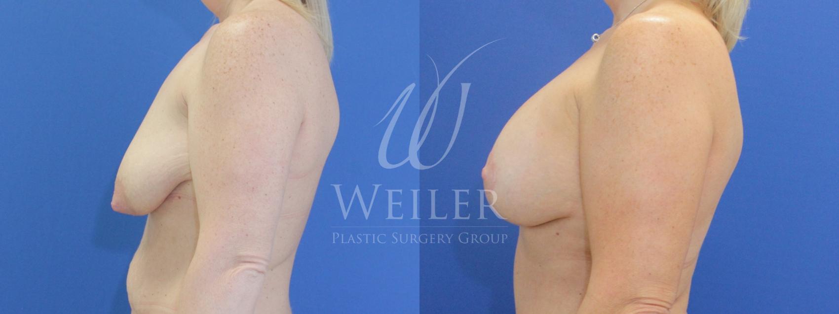 Before & After Breast Lift with Augmentation Case 789 Left Side View in Baton Rouge, Louisiana