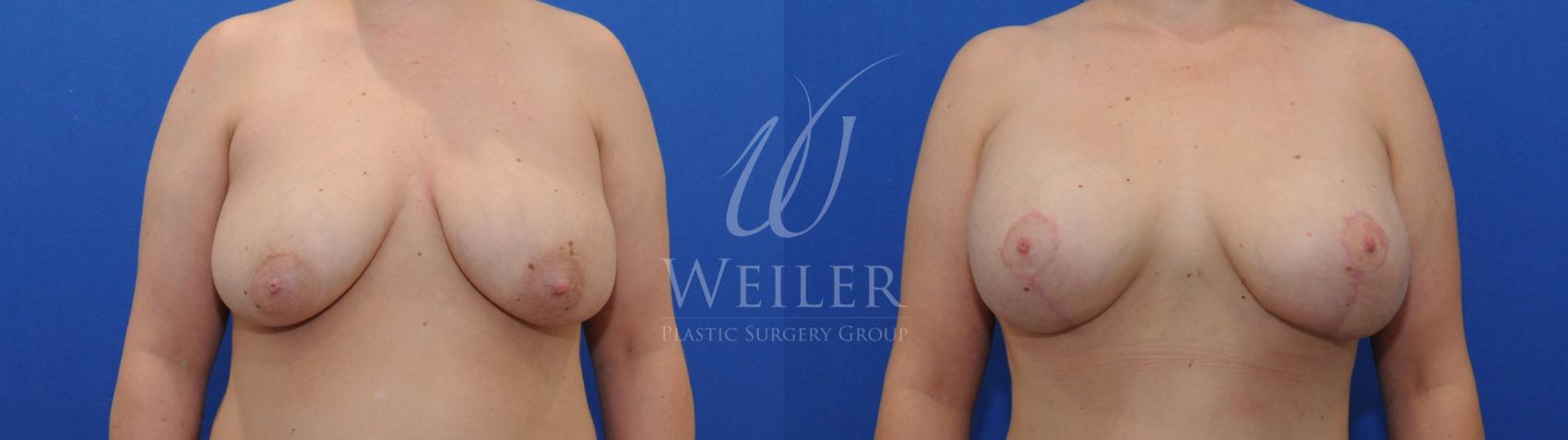 Before & After Breast Lift with Augmentation Case 796 Front View in Baton Rouge, Louisiana