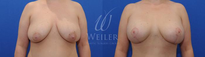 Before & After Breast Lift with Augmentation Case 796 Front View in Baton Rouge, New Orleans, & Lafayette, Louisiana