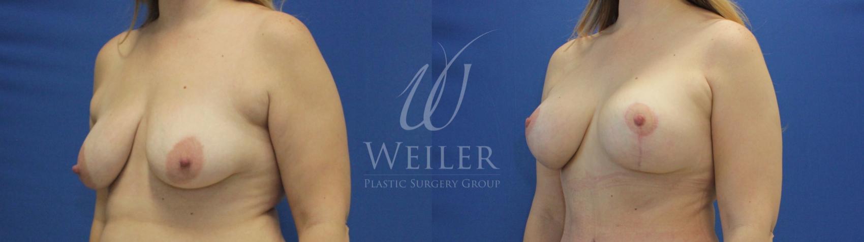 Before & After Breast Lift with Augmentation Case 798 Left Oblique View in Baton Rouge, Louisiana