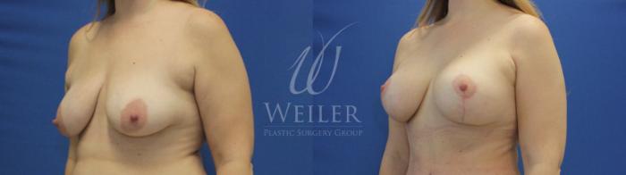 Before & After Breast Lift with Augmentation Case 798 Left Oblique View in Baton Rouge, New Orleans, & Lafayette, Louisiana
