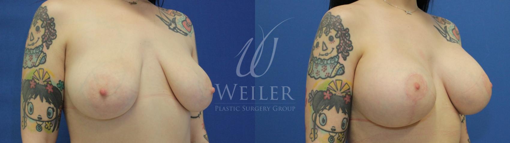 Before & After Breast Lift with Augmentation Case 802 Right Oblique View in Baton Rouge, New Orleans, & Lafayette, Louisiana