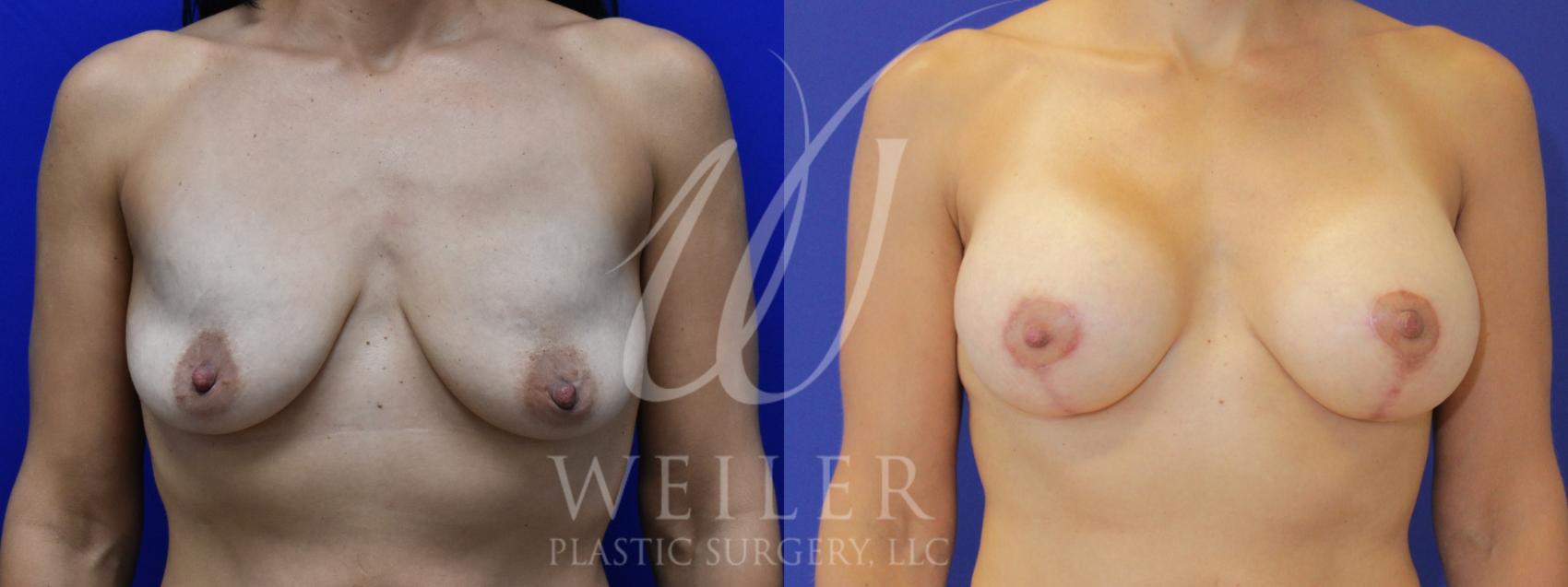Before & After Breast Lift with Augmentation Case 890 Front View in Baton Rouge, New Orleans, & Lafayette, Louisiana