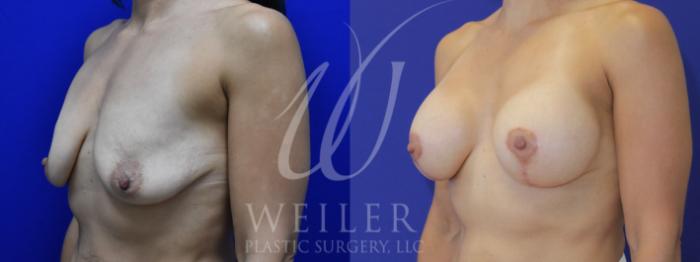 Before & After Breast Lift with Augmentation Case 890 Left Oblique View in Baton Rouge, Louisiana