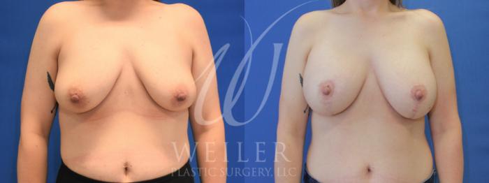 Before & After Breast Lift with Augmentation Case 895 Front View in Baton Rouge, New Orleans, & Lafayette, Louisiana