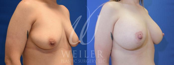 Before & After Breast Lift with Augmentation Case 895 Right Oblique View in Baton Rouge, New Orleans, & Lafayette, Louisiana