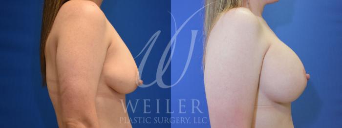 Before & After Breast Lift with Augmentation Case 895 Right Side View in Baton Rouge, New Orleans, & Lafayette, Louisiana