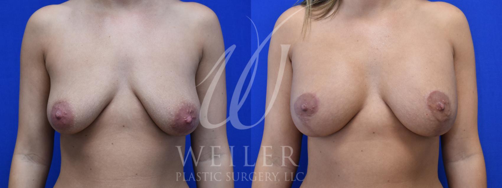 Before & After Breast Lift with Augmentation Case 897 Front View in Baton Rouge, New Orleans, & Lafayette, Louisiana