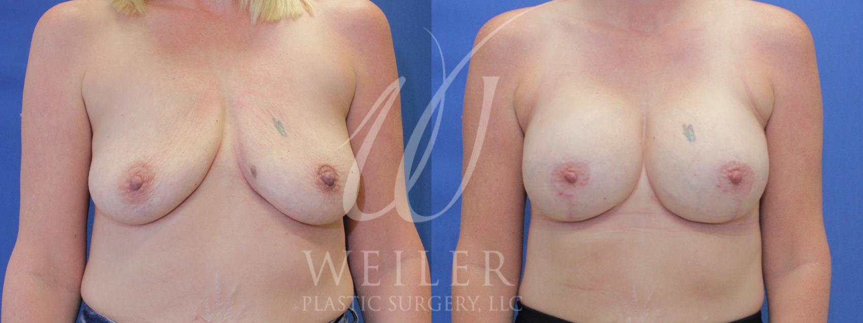 Before & After Breast Lift with Augmentation Case 912 Front View in Baton Rouge, Louisiana