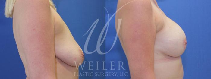 Before & After Breast Lift with Augmentation Case 912 Right Side View in Baton Rouge, Louisiana