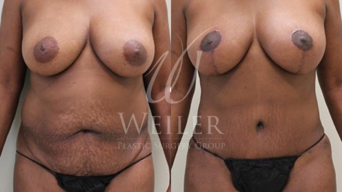 Before & After Breast Lift with Augmentation Case 93 Front View in Baton Rouge, New Orleans, & Lafayette, Louisiana