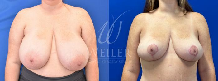 Before & After Breast Reduction Case 1056 Front View in Baton Rouge, Louisiana