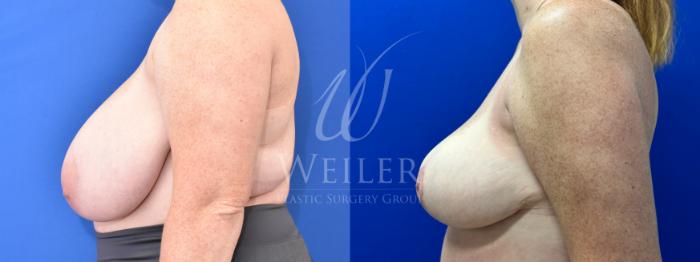 Before & After Breast Reduction Case 1056 Left Side View in Baton Rouge, New Orleans, & Lafayette, Louisiana