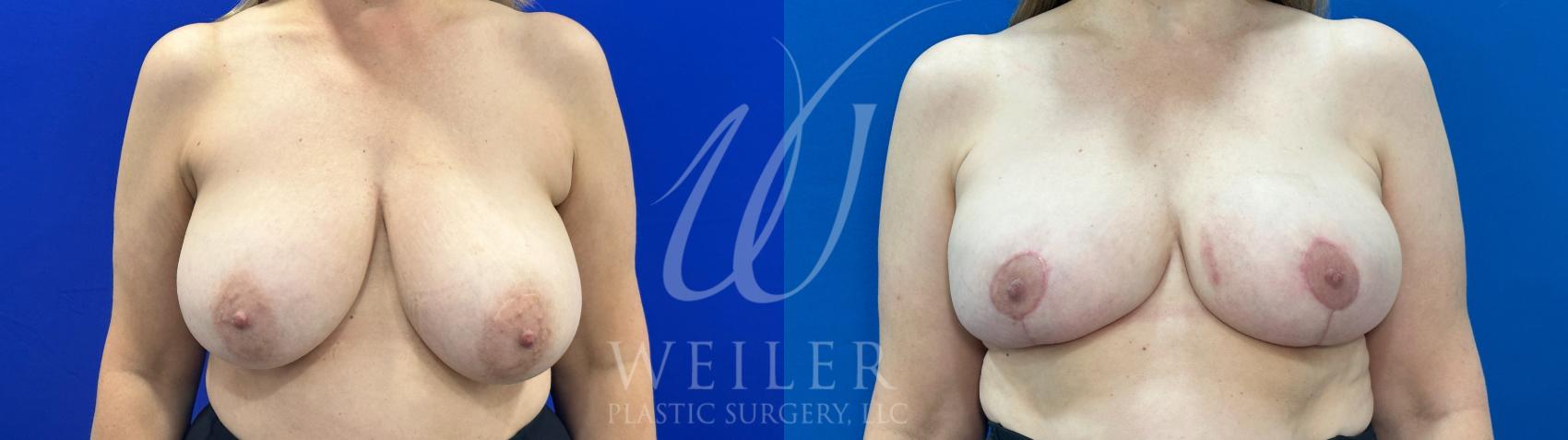 Before & After Breast Reduction Case 1078 Front View in Baton Rouge, New Orleans, & Lafayette, Louisiana