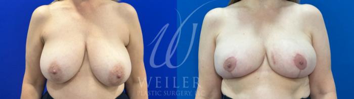 Before & After Breast Reduction Case 1078 Front View in Baton Rouge, Louisiana
