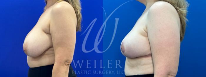 Before & After Breast Reduction Case 1078 Left Side View in Baton Rouge, New Orleans, & Lafayette, Louisiana