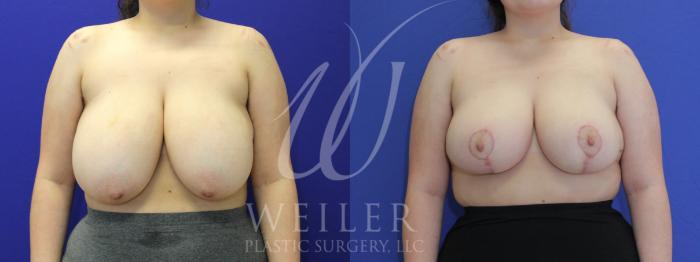 Before & After Breast Reduction Case 1099 Front View in Baton Rouge, New Orleans, & Lafayette, Louisiana