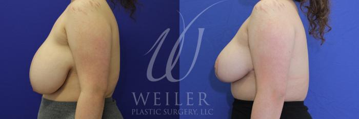 Before & After Breast Reduction Case 1099 Left Side View in Baton Rouge, New Orleans, & Lafayette, Louisiana