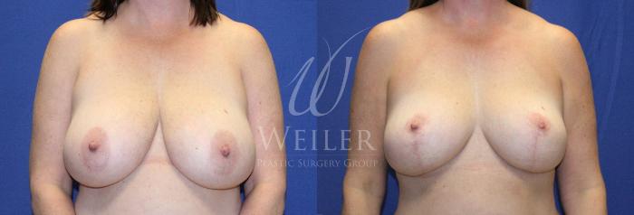 Before & After Breast Reduction Case 1134 Front View in Baton Rouge, New Orleans, & Lafayette, Louisiana