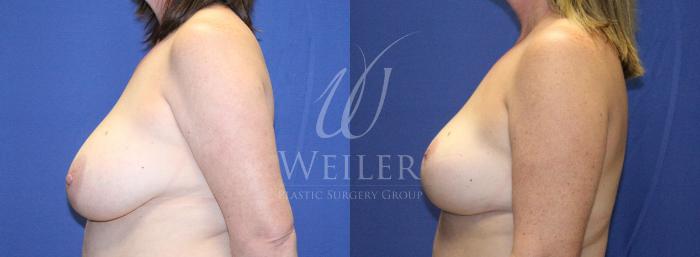 Before & After Breast Reduction Case 1134 Right Side View in Baton Rouge, New Orleans, & Lafayette, Louisiana
