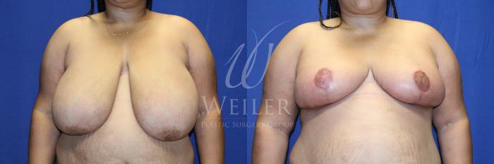 Before & After Breast Reduction Case 1150 Front View in Baton Rouge, New Orleans, & Lafayette, Louisiana