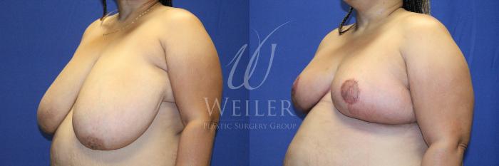 Before & After Breast Reduction Case 1150 Right Oblique View in Baton Rouge, New Orleans, & Lafayette, Louisiana