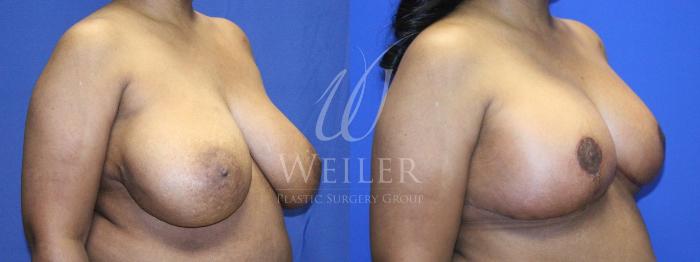 Before & After Breast Reduction Case 1151 Left Oblique View in Baton Rouge, New Orleans, & Lafayette, Louisiana
